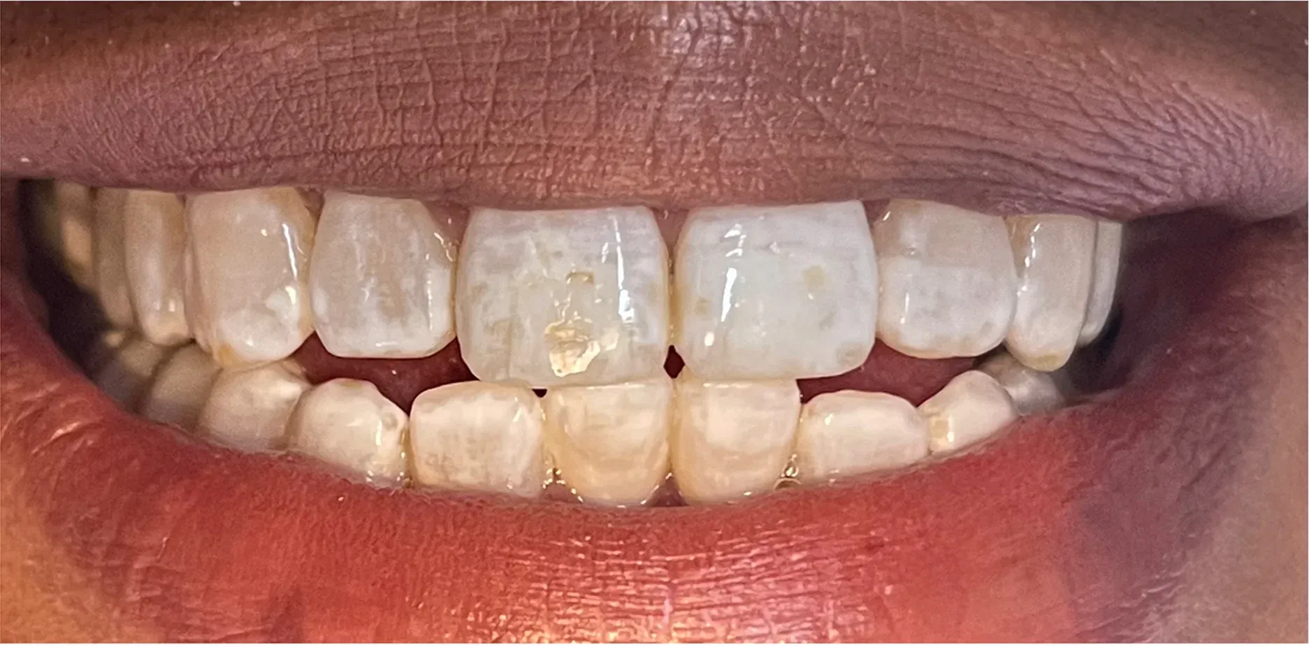 Before: Yellowed, Dull Enamel