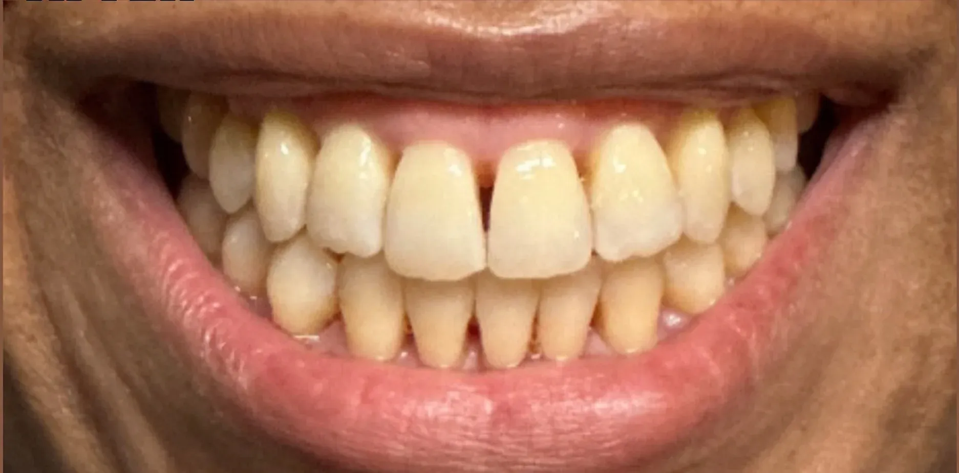 After: Corrected Bite and Improved Alignment