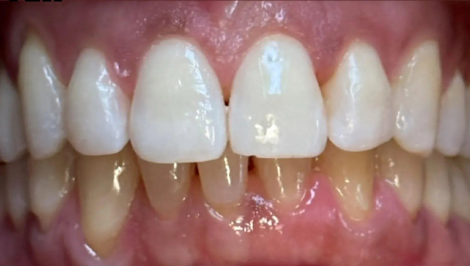 After: Transformed Smile with Proper Alignment