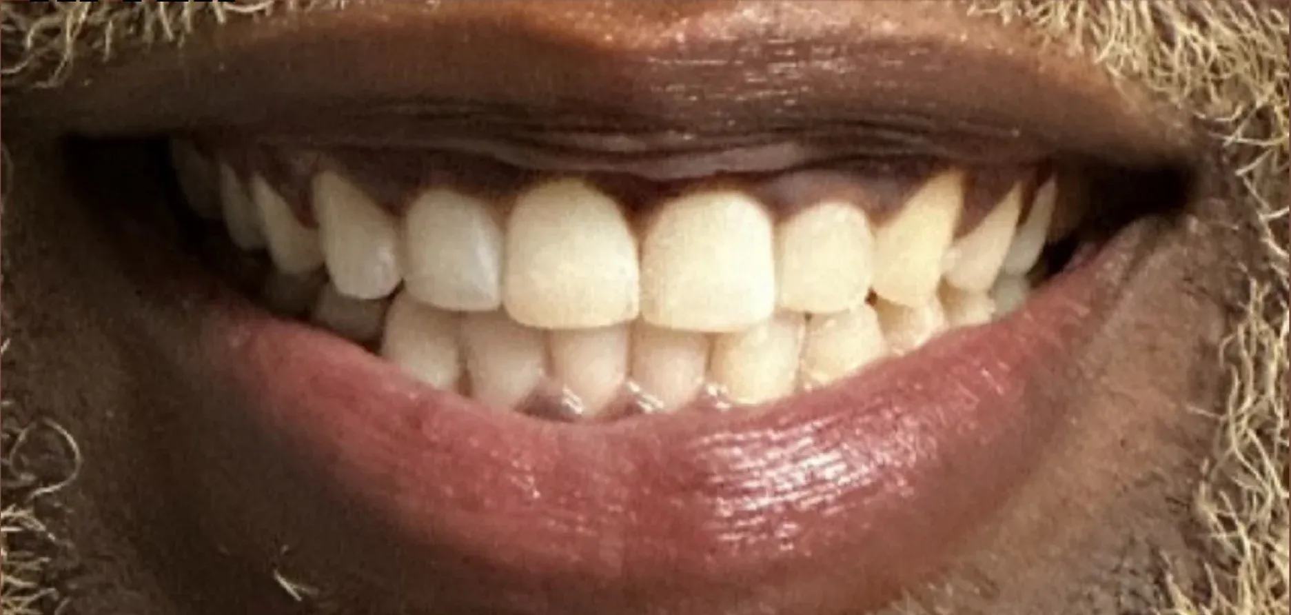After: Straight, Well-Aligned Smile Through Invisalign