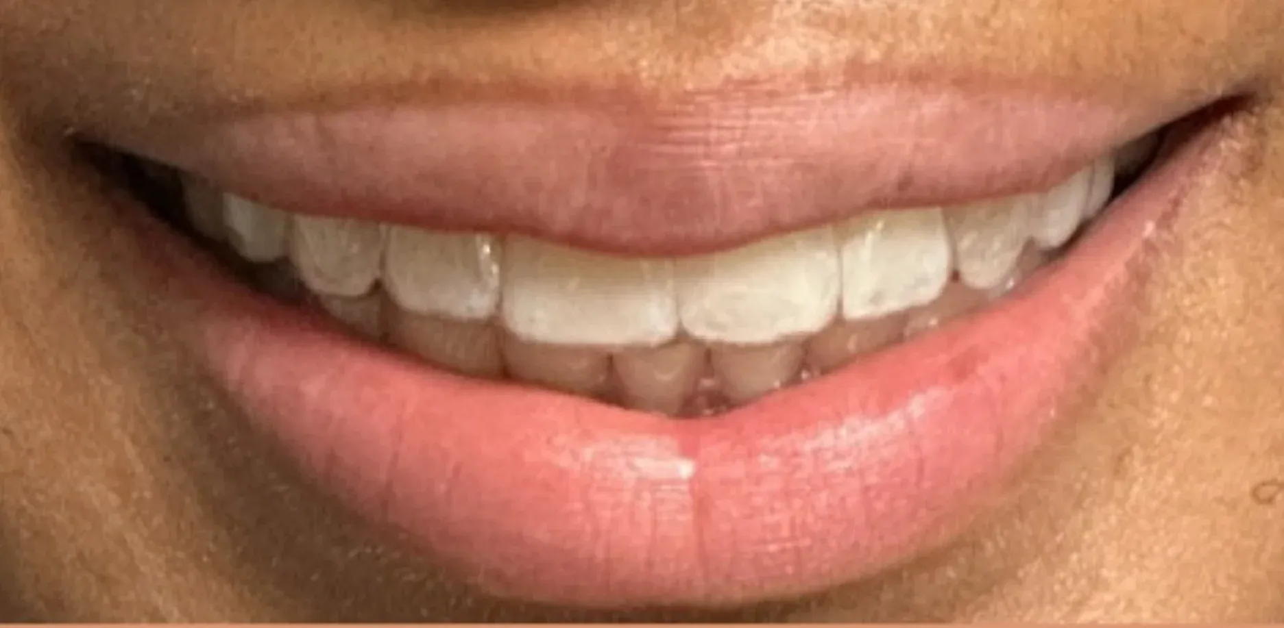After: Beautifully Aligned Smile with Invisalign