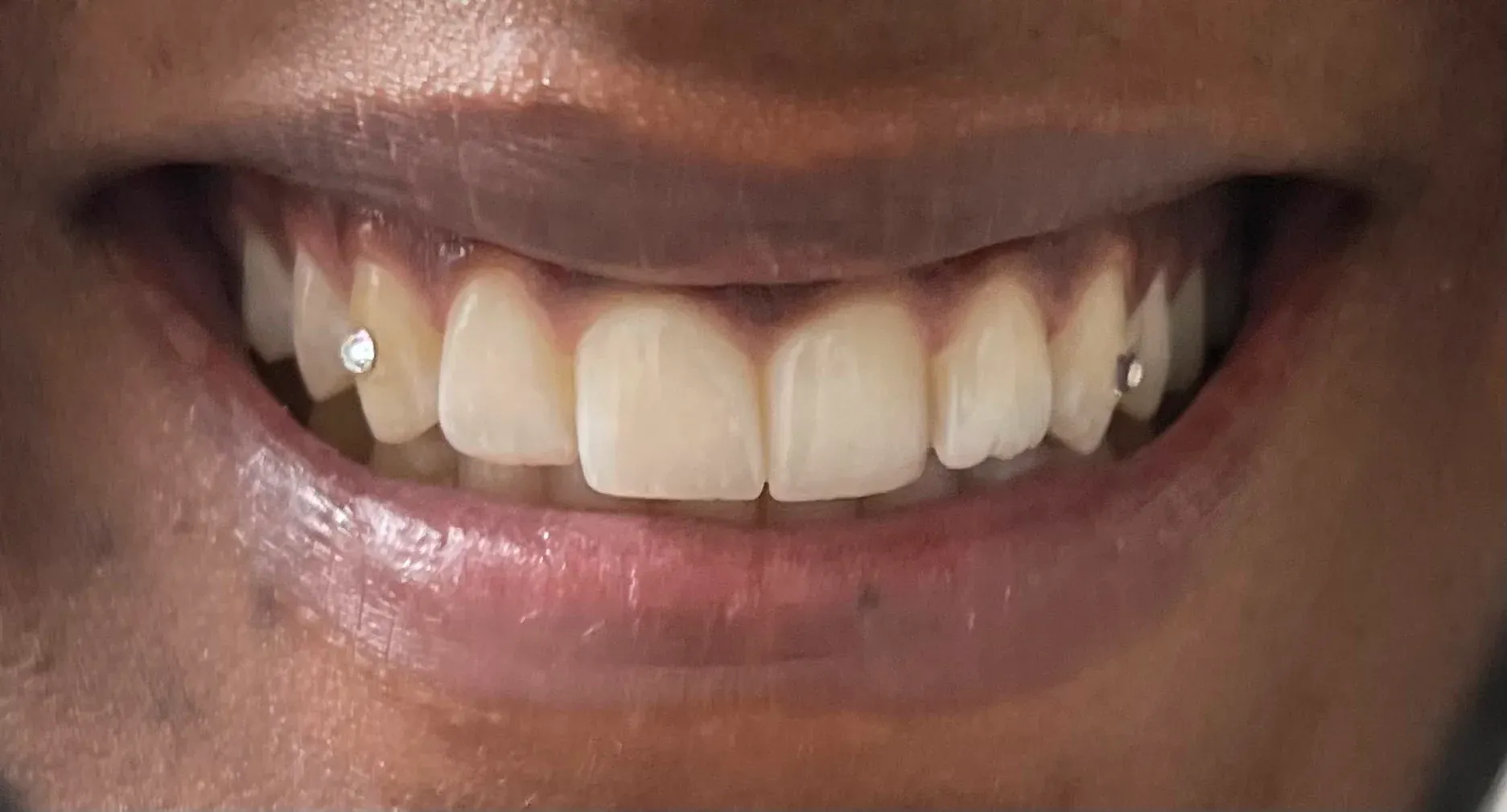 After: Dazzling Smile Upgrade