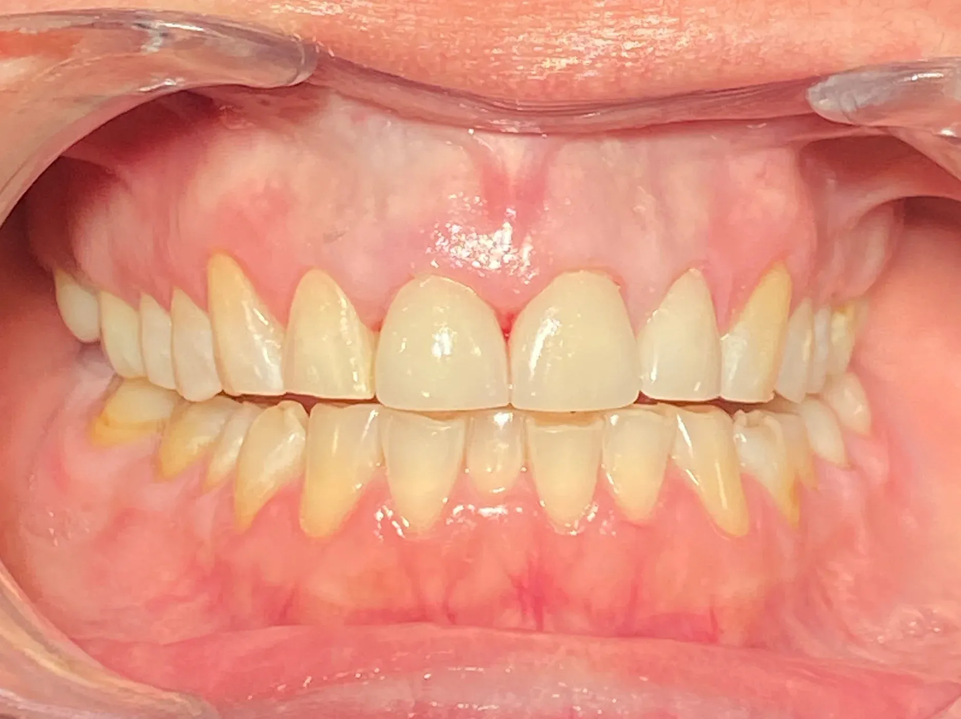 After: A Custom Blend of Crowns and Veneers