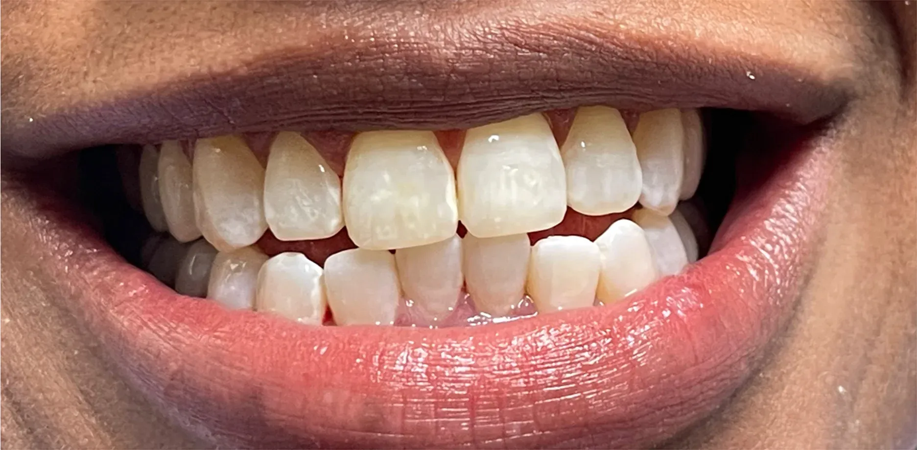 After: Brighter, Confident Smile