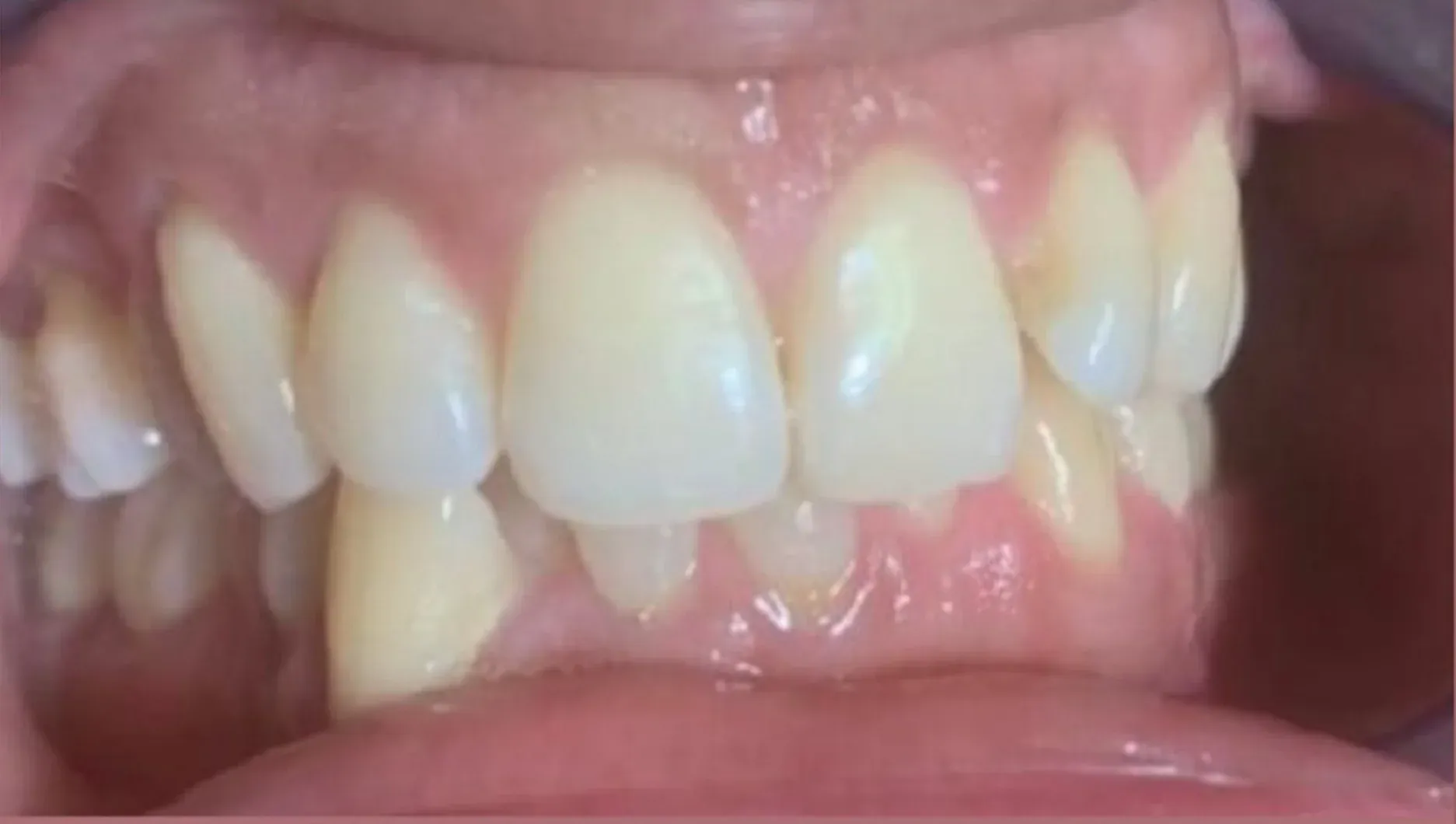 Before: Severe Crowding and Rotated Teeth