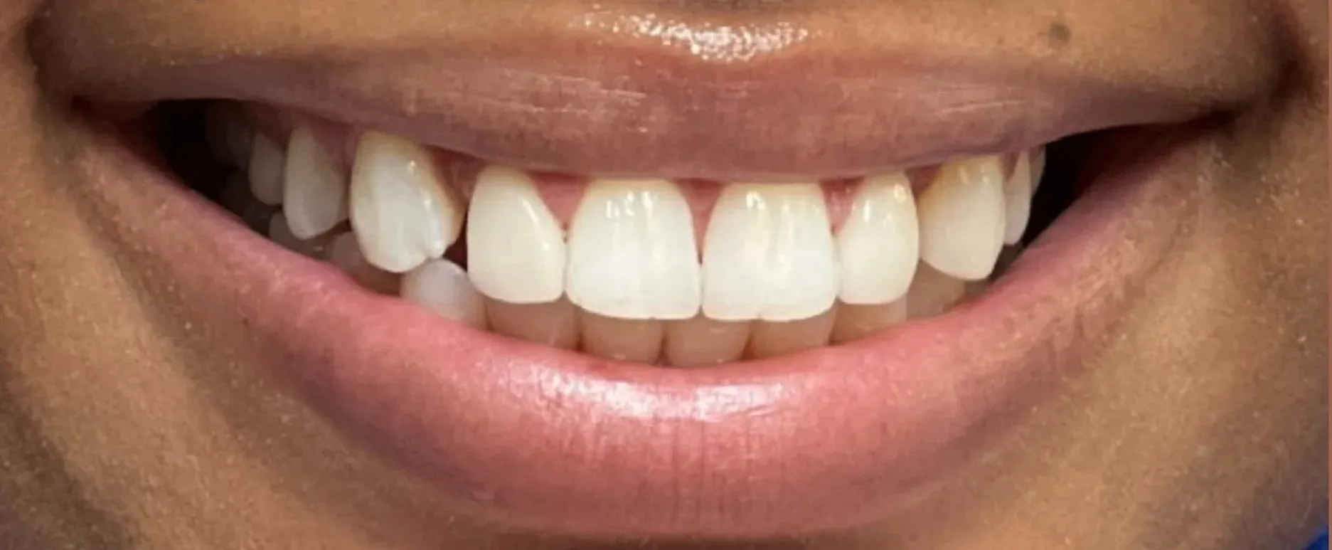 Before: Spacing Issues and Uneven Front Teeth