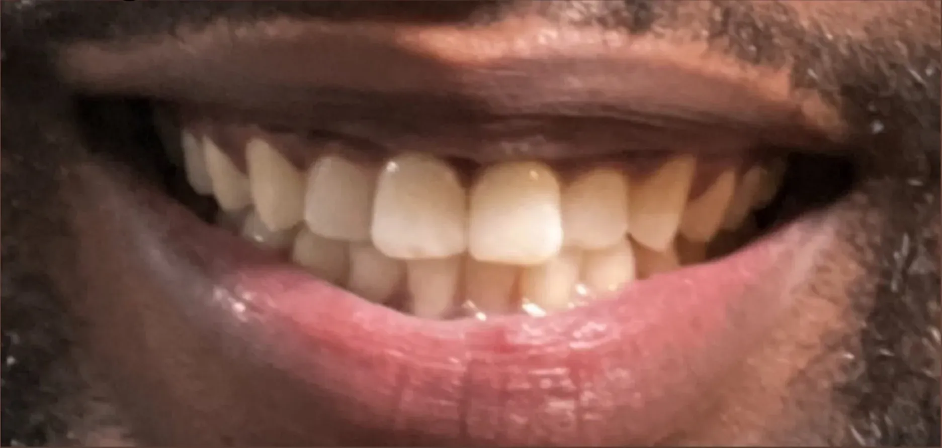 Before: Overlapping and Protruding Front Teeth