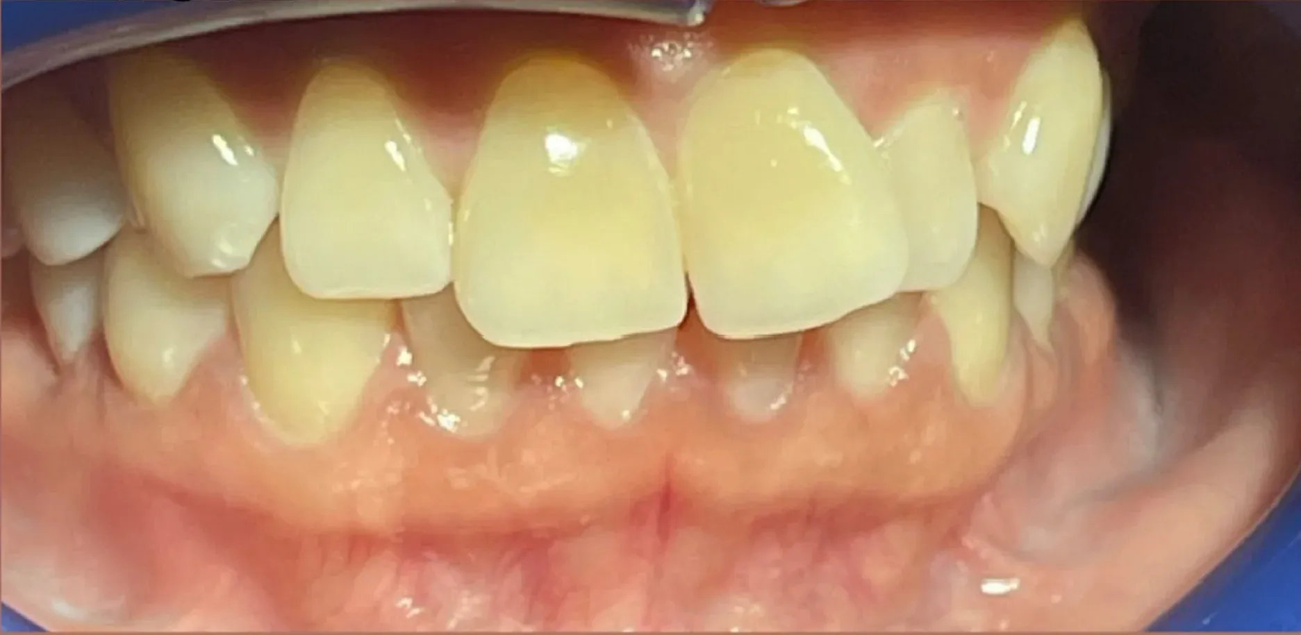 Before: Severe Staining and Discoloration