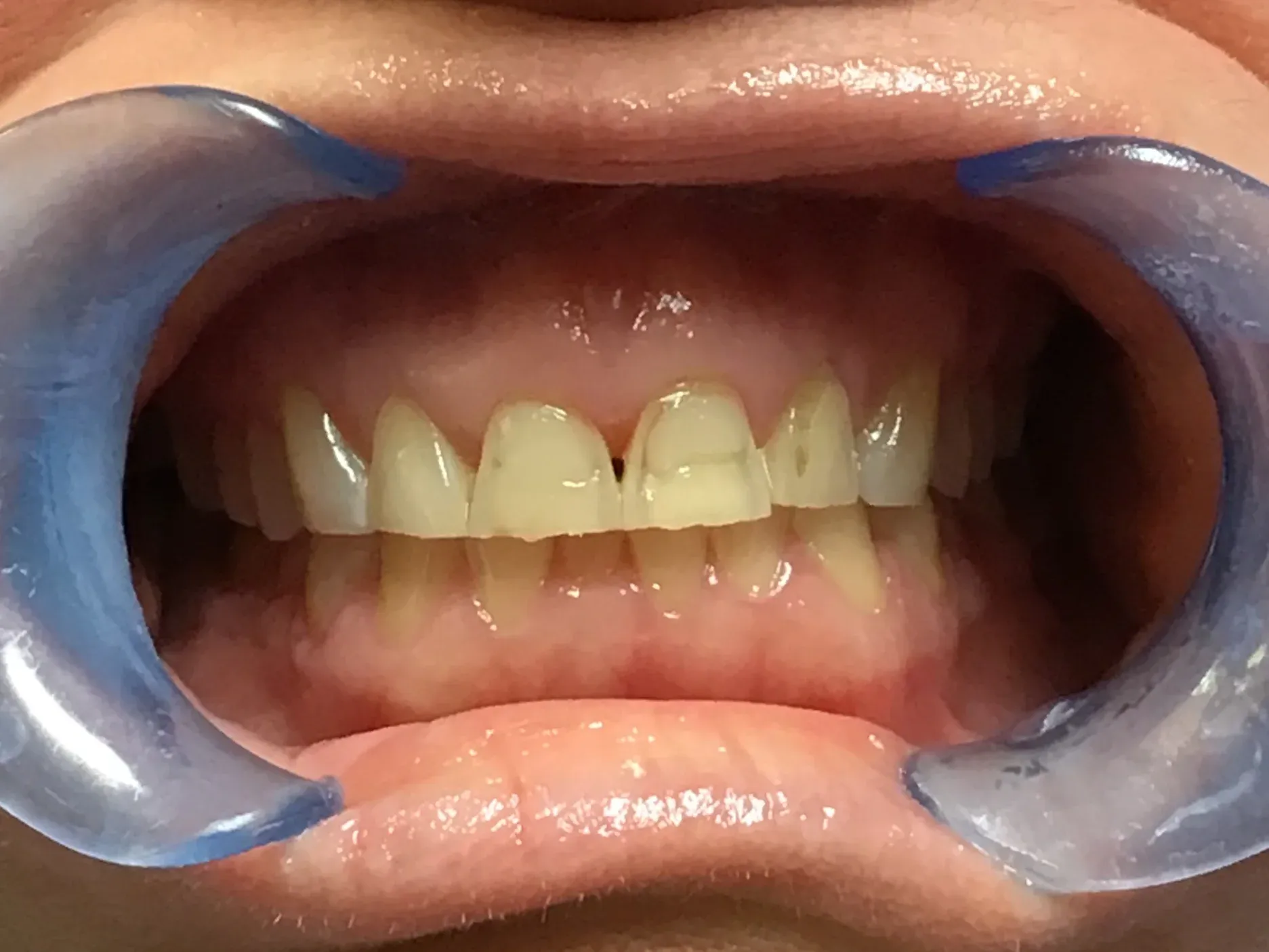 Before: Worn Edges and Uneven Smile Line