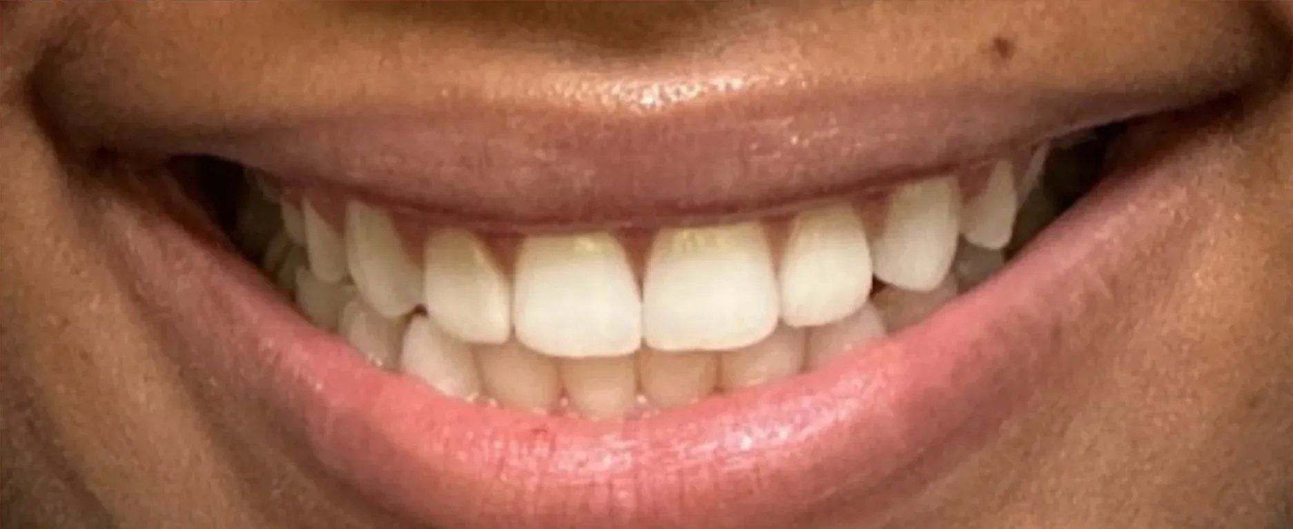 After: Closed Gaps and Perfectly Aligned Teeth
