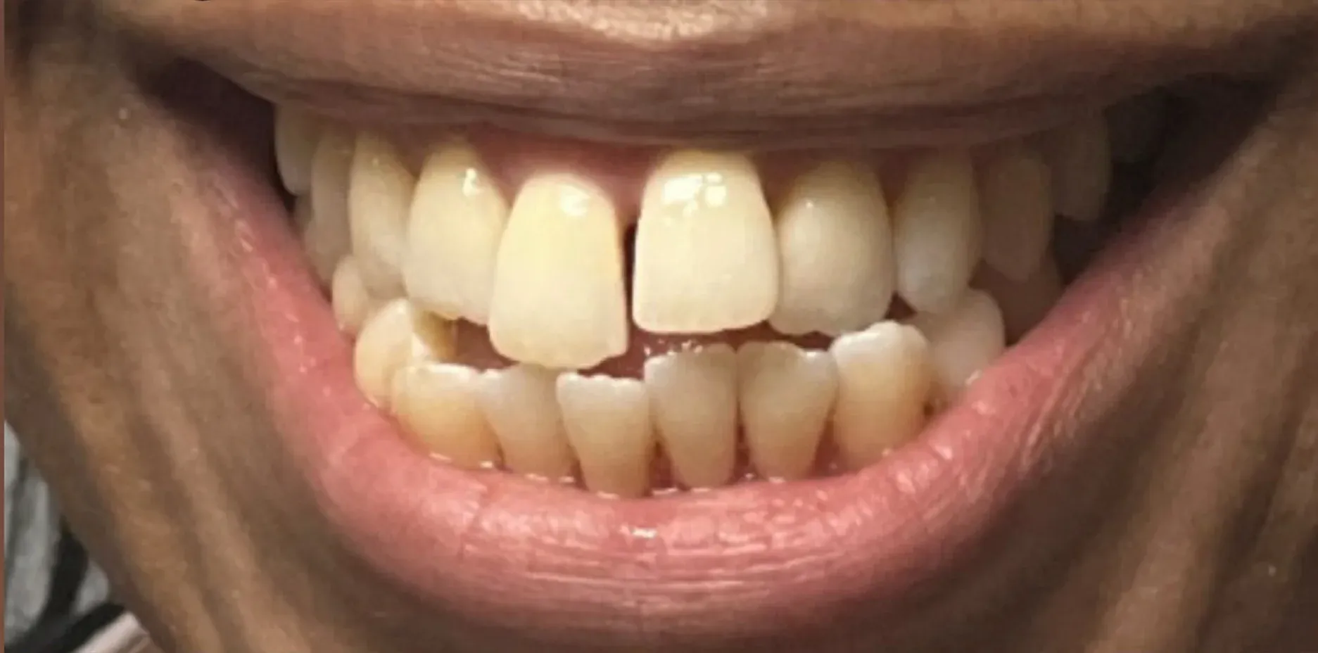 Before: Misaligned Bite and Crowded Lower Teeth
