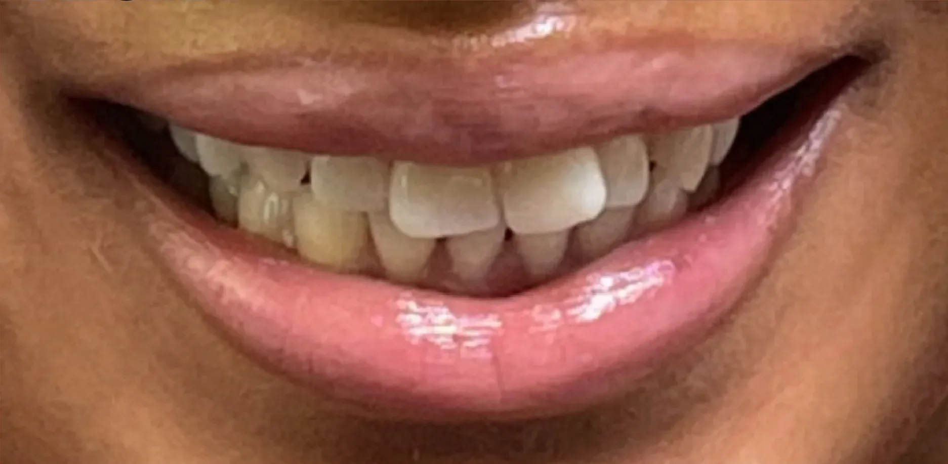 Before: Crowded and Misaligned Front Teeth
